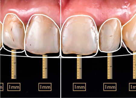 Diseño digital de sonrisas