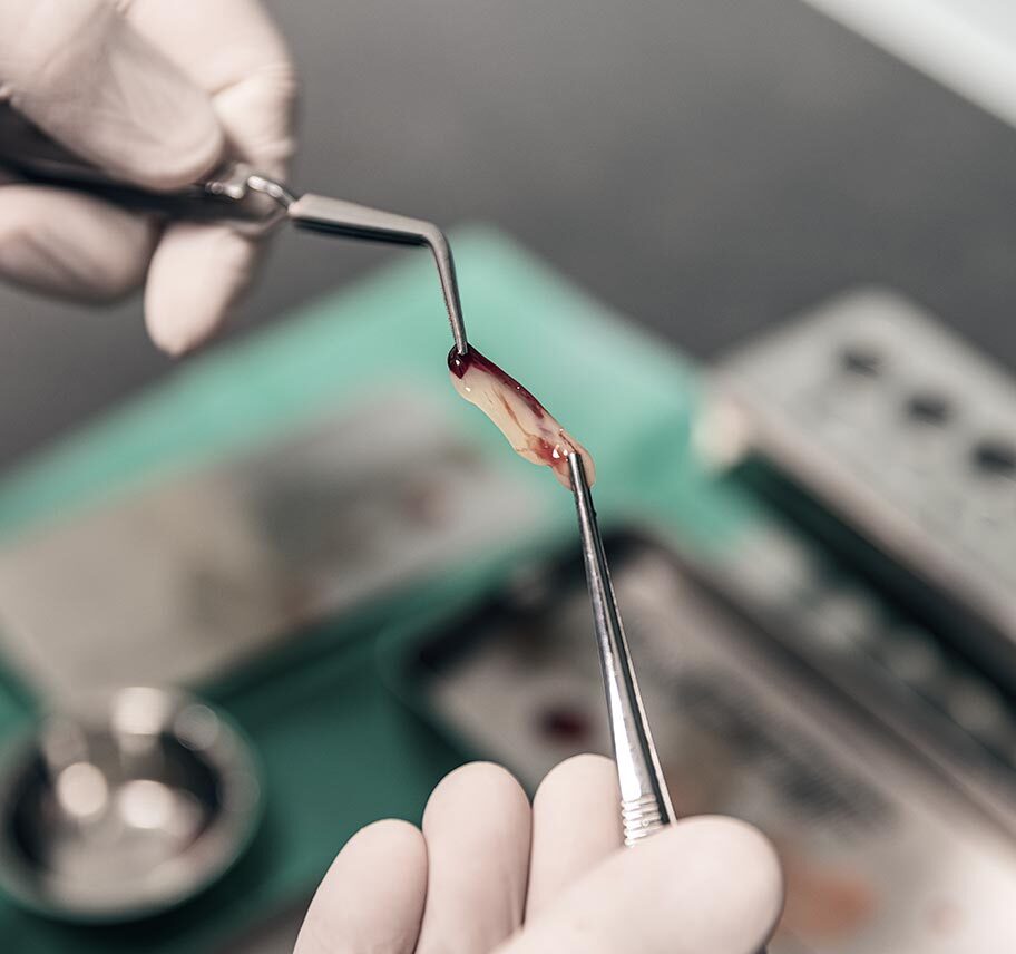 Injerto oseo en espátula a punto de ser injertado en diente